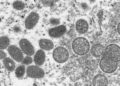 What Is Monkeypox and Where Is It Spreading?