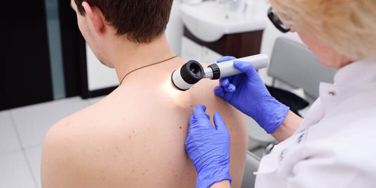 Allina Health resumes free skin cancer screenings as cases surge